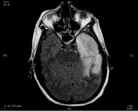 Herpes Dementia