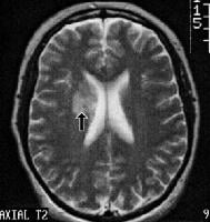 Lupus Brain Mri