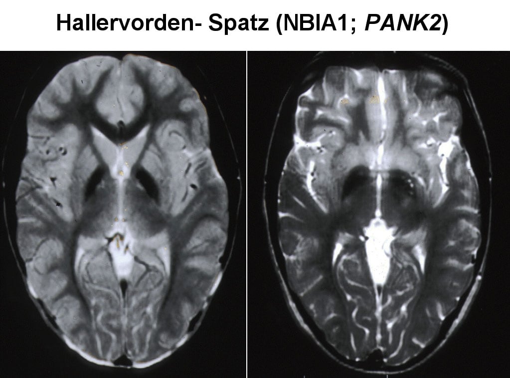  likelihood of antemortem diagnosis of Hallervorden-Spatz (HSD) disease.