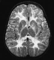 Krabbe Disease Mri