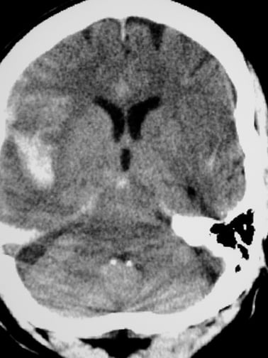 ct scan with contrast headache