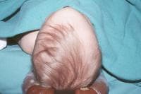 Pediatric Craniosynostosis Clinical Presentation