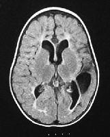 MRI of a 16-month-old boy who was born at term bu...