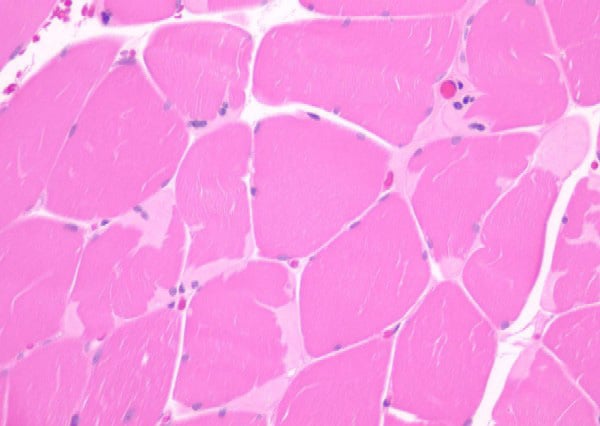 Inclusions on hematoxylin-eosinstained par...