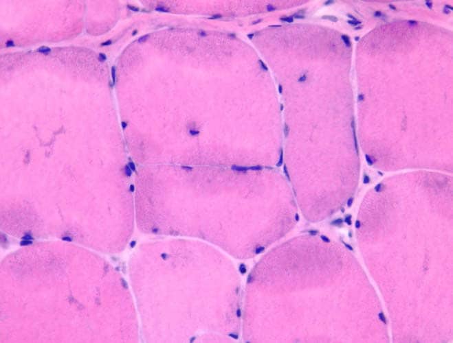 Dystrophinopathy, Becker muscular dystrophy, on h...