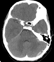 Extradural Hemorrhage