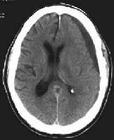 A left-sided chronic subdural hematoma (SDH). Note