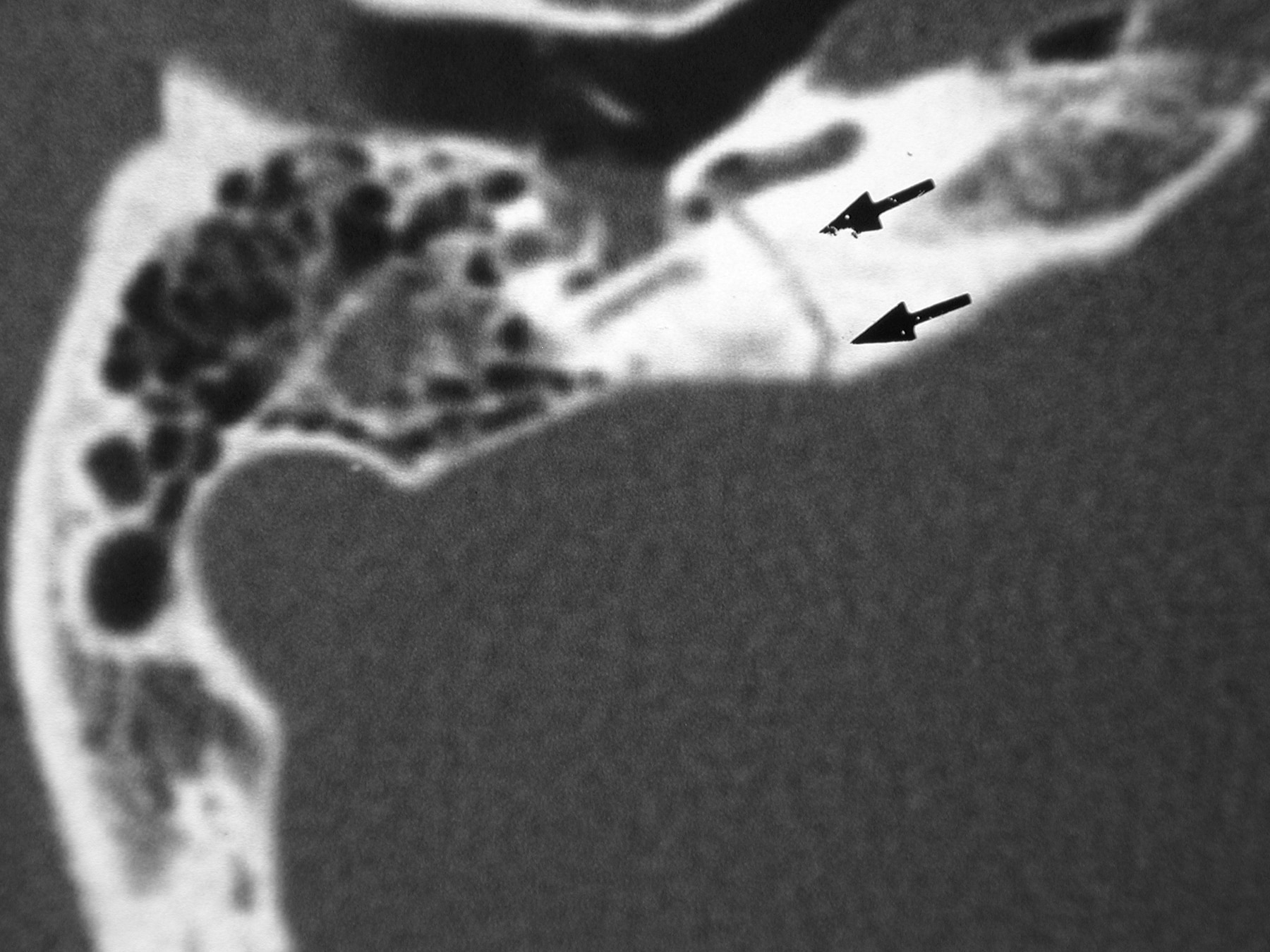 Transverse temporal bone  fracture (courtesy of Ad...