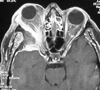 Sphenoid Wing Meningioma