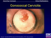 mucopurulent cervicitis