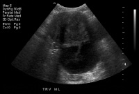 Transabdominal ultrasonogram. This image shows ane