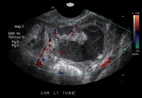 Endovaginal ultrasonogram. This image reveals a tu