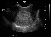 This ultrasonogram shows a markedly heterogeneous 
