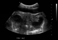 Transabdominal ultrasonogram. This image demonstra