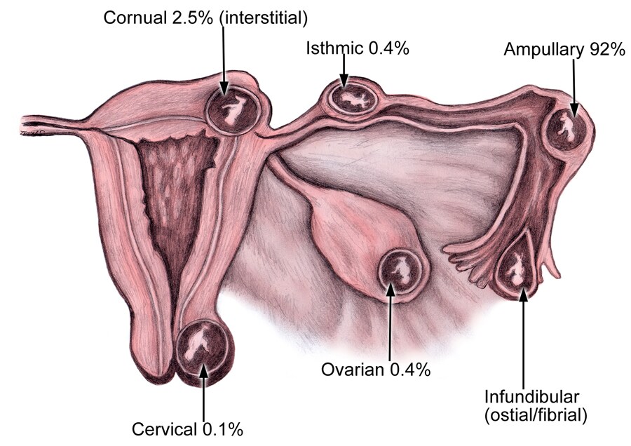 Sites of ectopic pregnancies.