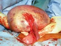 Ovarian Cysts Images