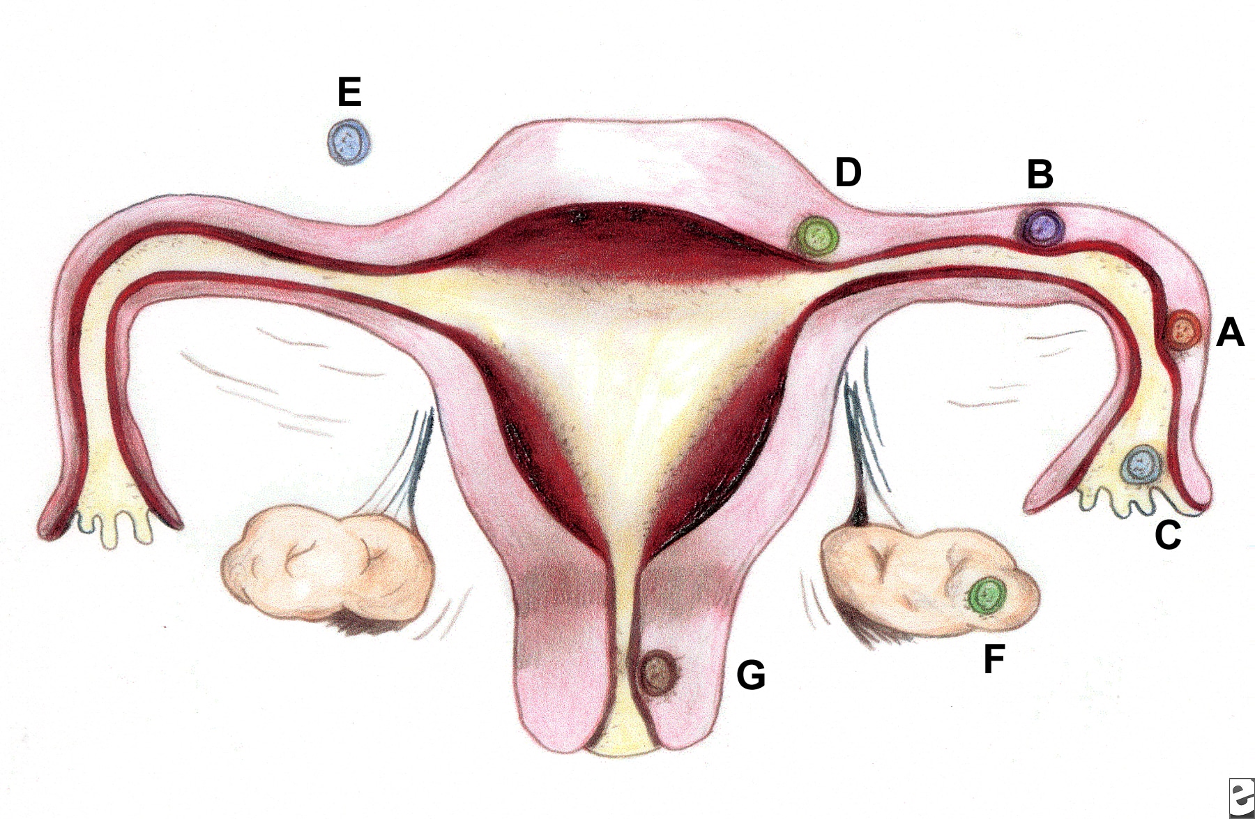 Ectopic Pregnancy At 2 Weeks