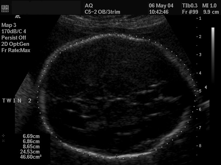 Ultrasonographic image of a fetal head, with meas...