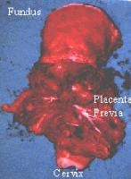 placenta previa pathophysiology