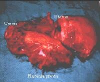 Results 1 - 10. Interventions for treating placental abruption There is no evidence frombabies.  Gaufberg SV; Abruptio placentae, eMedicine, Dec 2008.treating.