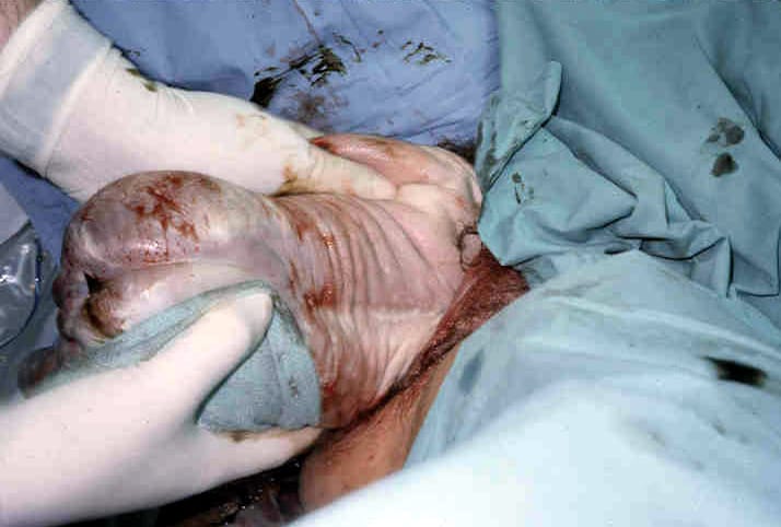 Assisted vaginal breech delivery The anterior ar