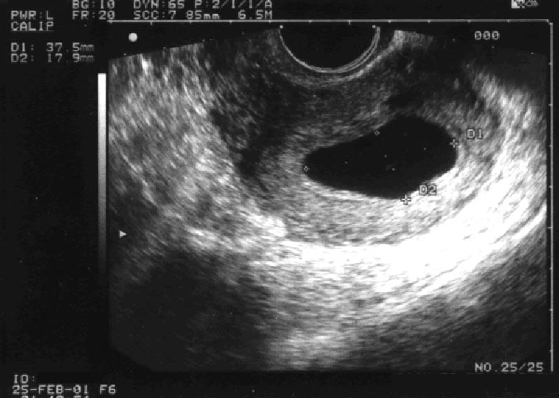 This is a gestational sac (GS) that measures approximately 2 X 3 cm, 