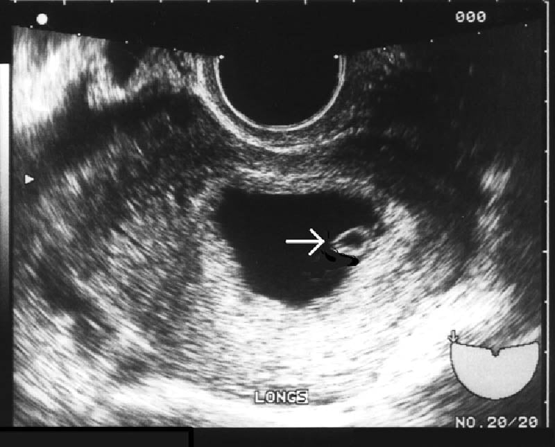 10 weeks pregnant. Pregnancy diagnosis.