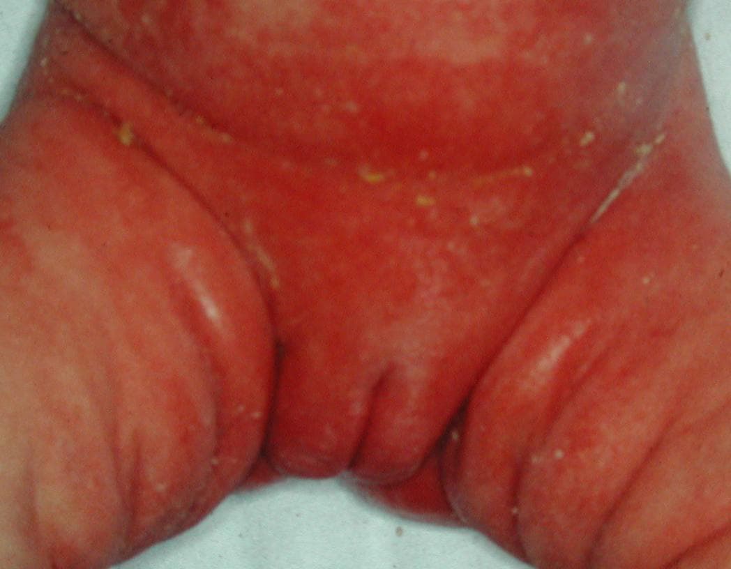 Dermatitis Vulva