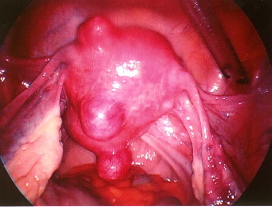 Small uterine myomas visualized at laparoscopy.