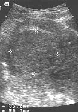 Uterine leiomyoma as seen on ultrasound imaging. ...