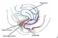 Enterocele and massive vaginal eversion. Posterio...