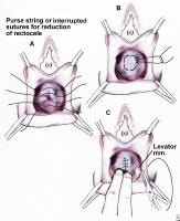 fistule recto vaginal