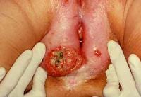 cervical biopsy discharge