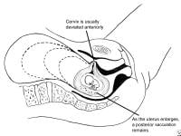 Deviated Uterus