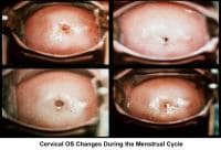Infertility. Cervical os changes during the menst...