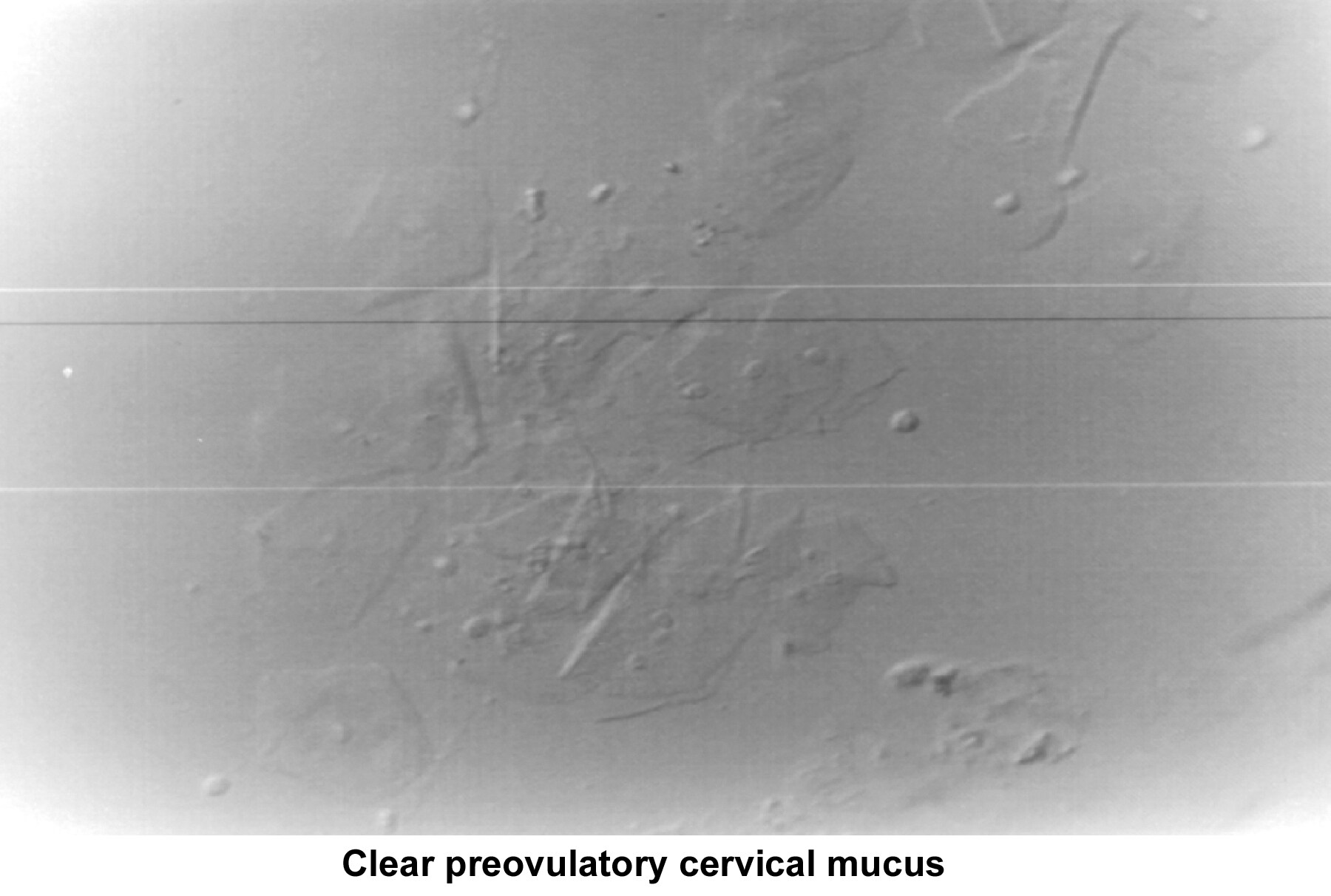 Infertility. Clear preovulatory cervical mucus. I...
