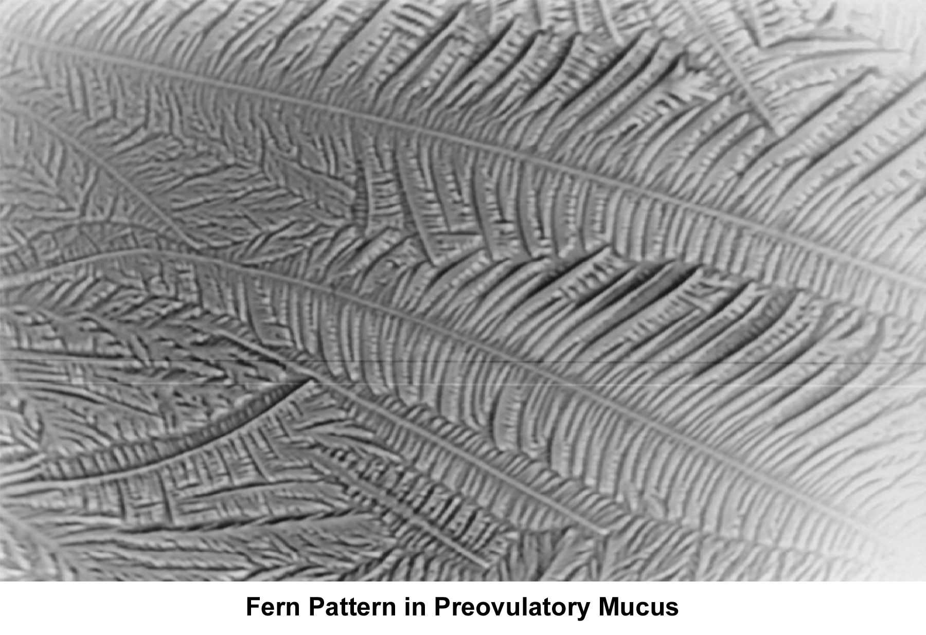 Infertility. Fern pattern of preovulatory mucus. ...