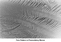 Infertility. Fern pattern of preovulatory mucus. ...