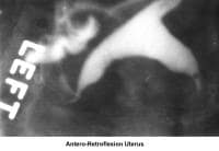Infertility. Antero-retroflexion uterus. Image c...