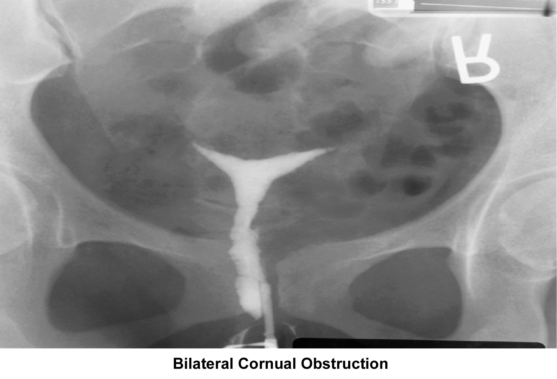 Infertility. Bilateral cornual obstruction. Imag...