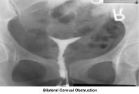 Infertility. Bilateral cornual obstruction. Imag...