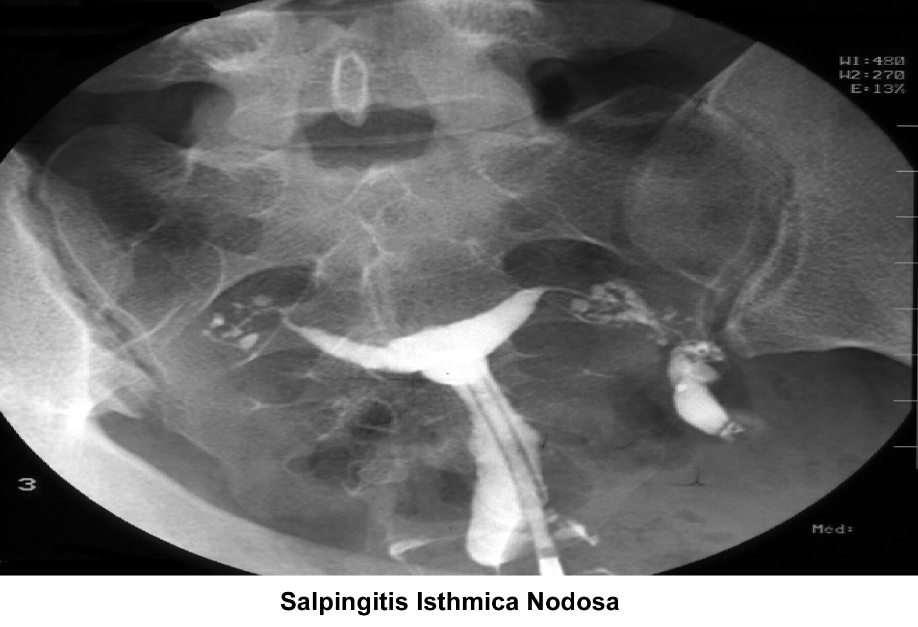 Infertility. Salpingitis isthmica nodosa. Image c...