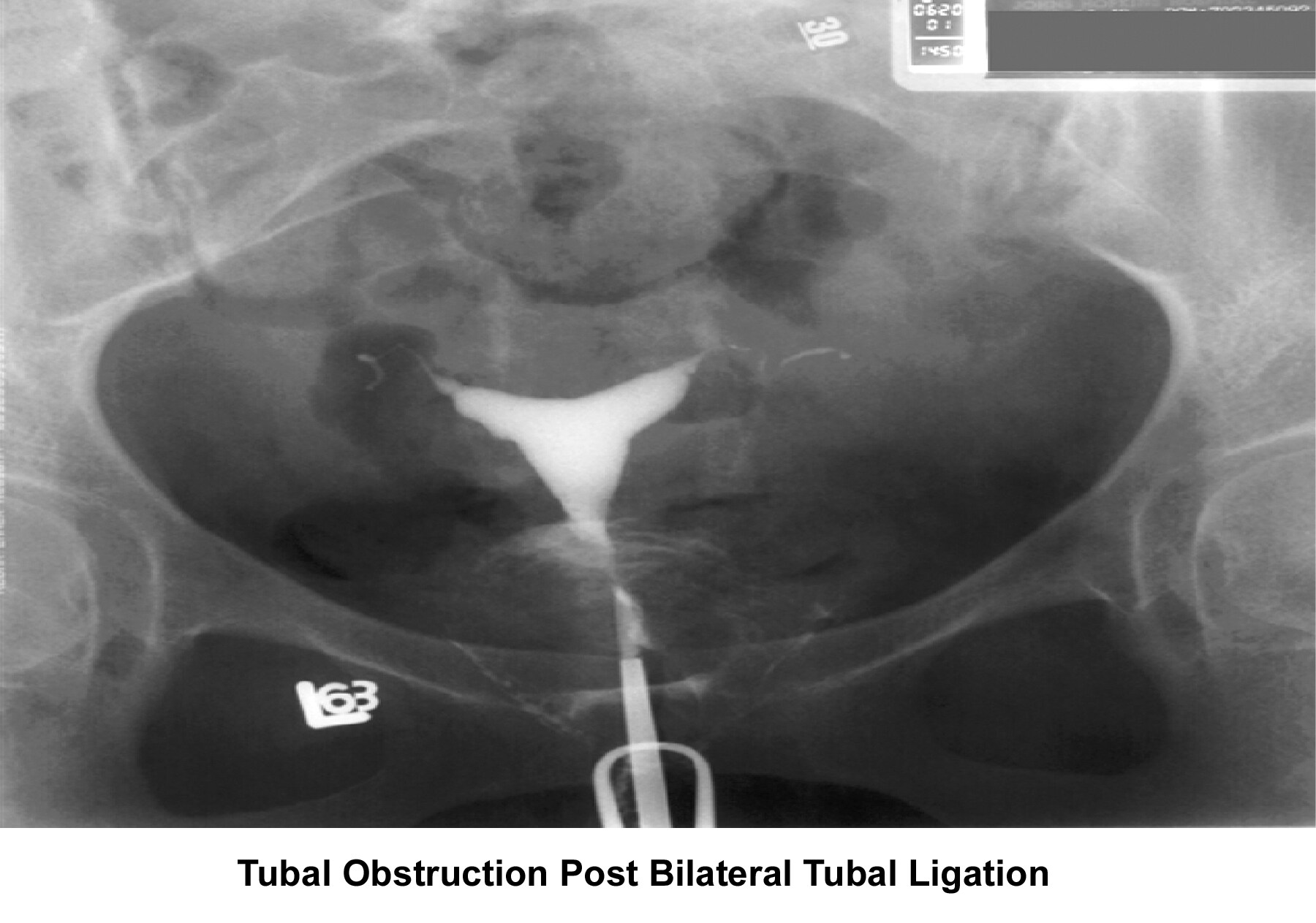 Infertility. Tubal obstruction post–bilatera...