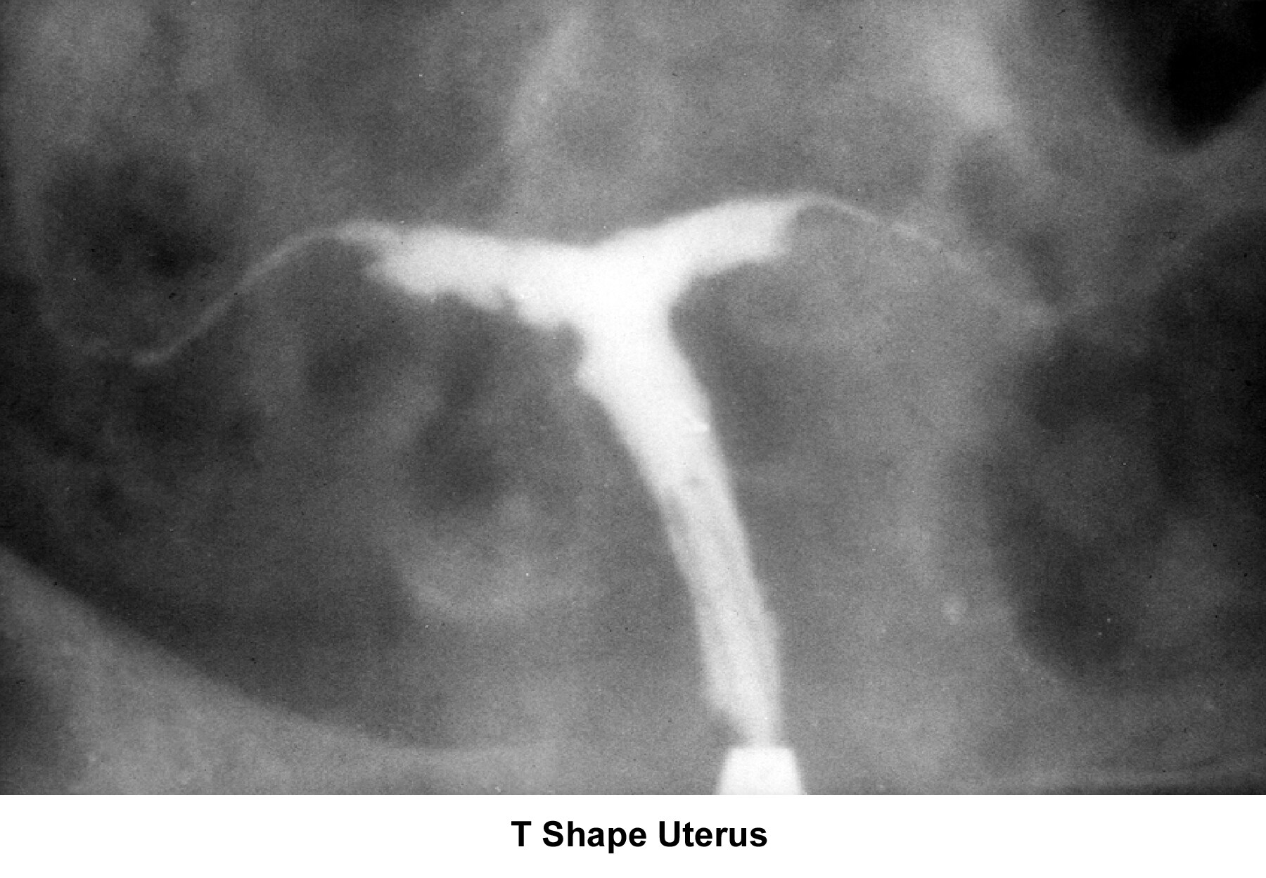Infertility. T-shaped uterus. Image courtesy of J...