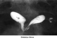 Infertility. Didelphys uterus. Image courtesy of ...