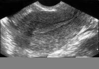 Infertility. Sonogram: Sagittal view of the uteru...