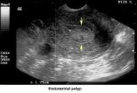 Infertility. Endometrial polyp. Image courtesy o...