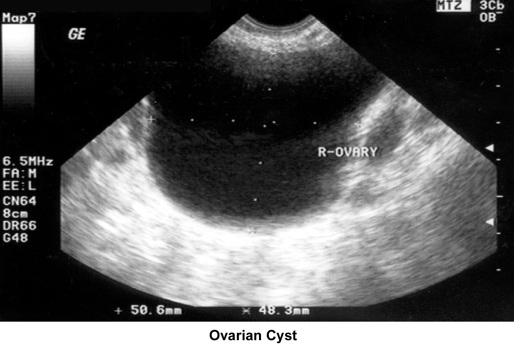 Infertility. Ovarian cyst. Image courtesy of Jair...
