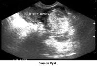 Infertility. Dermoid cyst. Image courtesy of Jai...