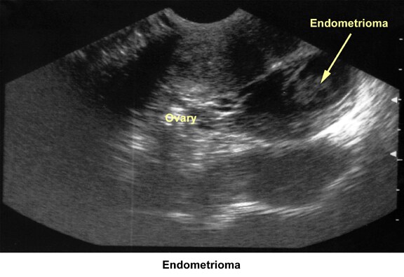 Infertility. Endometrioma. Image courtesy of Jai...